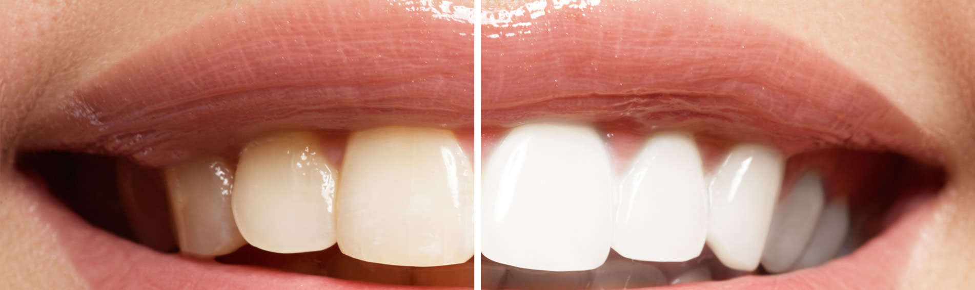 Teeth Whitening 1